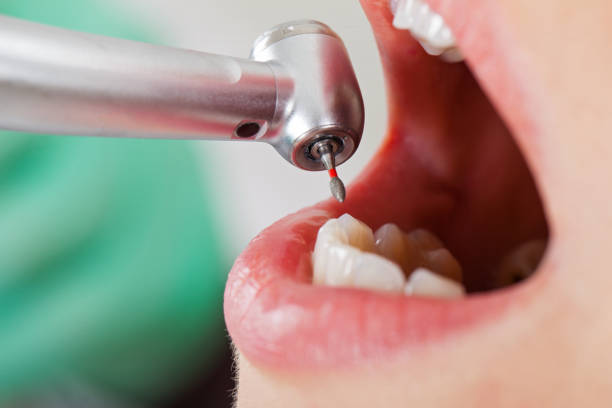 Best Emergency Root Canal Treatment in Ladonia, AL